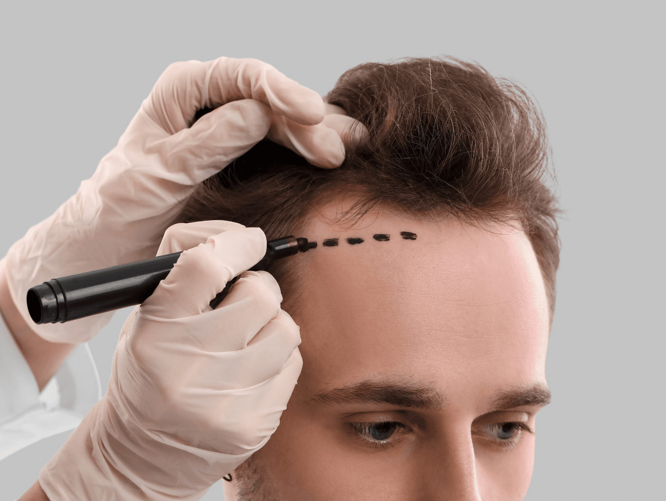 Client having a hairline marked during a private hair system consultation in a Weymouth salon