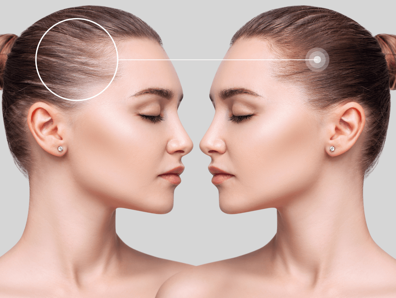 Side-by-side comparison of a woman’s hairline showing signs of hair thinning on the left and improved density on the right, illustrating results of trichology consultation and treatment.